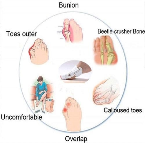 اعوجاج أصبع القدم الكبير طريقة تعديل انحراف إصبع القدم الكبير تصحيح عظمة القدم - جهاز التقويم