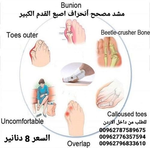 افضل طرق لعلاج انحراف إصبع القدم الكبير بدون جراحة