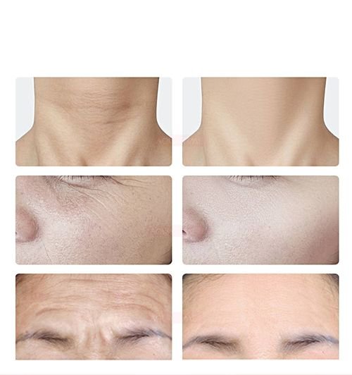 أفضل تقنية لشد الوجه علاج مشاكل البشره - شد البشرة اجهزة الترهلات -علاج ترهلات الجلد شد الوجه بدون
