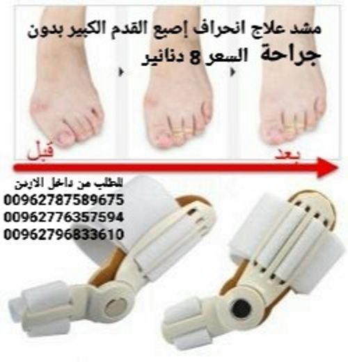 علاج إصبع القدم الكبير مصحح ٱنحراف اصبع القدم الكبير  للتخلص من بروز إبهام القدم بدون جراحة 