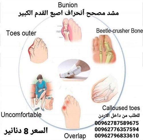 علاج إصبع القدم الكبير مصحح ٱنحراف اصبع القدم الكبير  للتخلص من بروز إبهام القدم بدون جراحة 